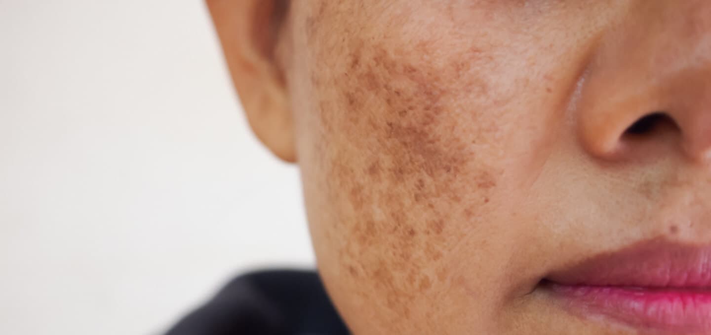 Brown pigmented patches on a woman's cheek, a typical presentation of melasma linked to sun and hormonal influences.