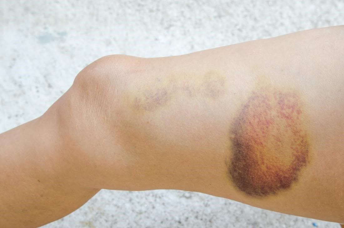 Yellow-purple hematoma on a leg near the knee, showing a healing bruise on the skin.