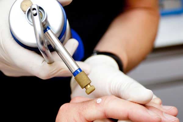 Gloved specialist using a cryotherapy device to treat a skin lesion on a patient's hand.
