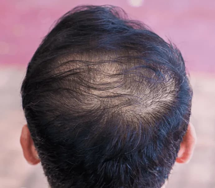 Back of a man's head showing thinning hair and diffuse hair loss across the crown.