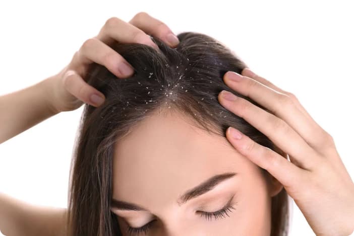 Woman parting her hair to reveal white flakes on the scalp, a common sign of dandruff and seborrheic dermatitis.