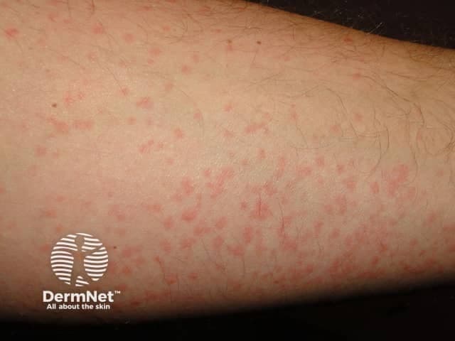 Scattered red spots and welts on the forearm, typical of cold-induced urticaria (hives).