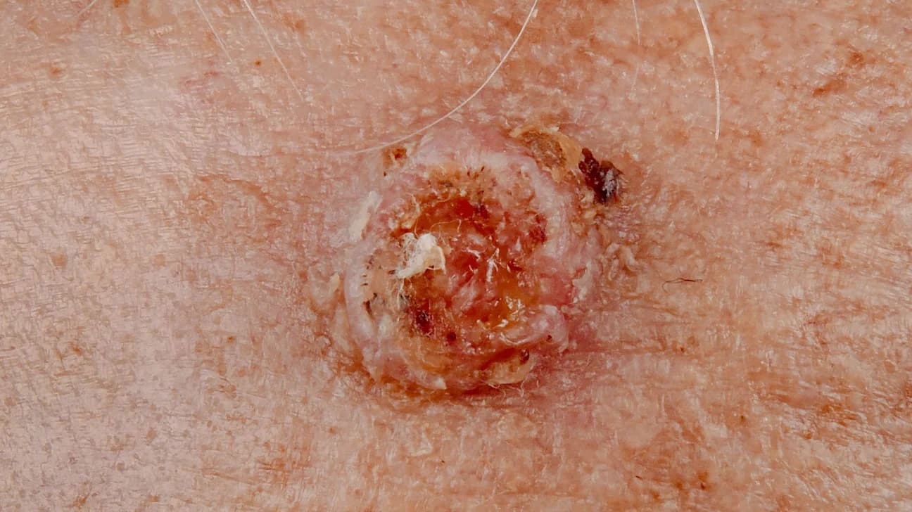 Crusted, ulcerated nodule on the skin, characteristic of squamous cell carcinoma, a form of skin cancer.