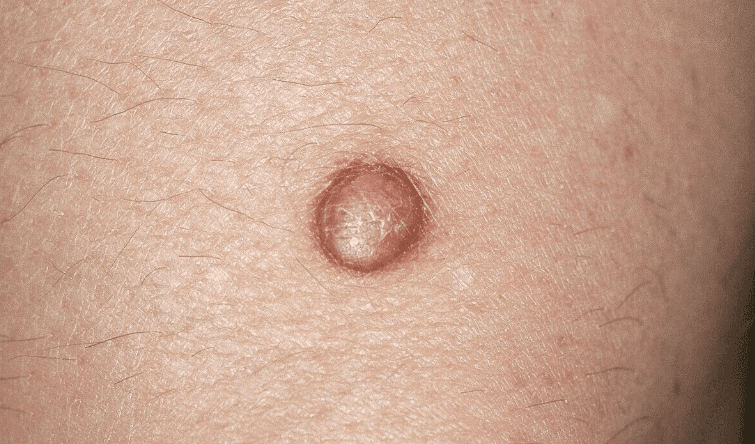 A small dome-shaped brownish dermatofibroma on the skin – a firm, benign nodule.