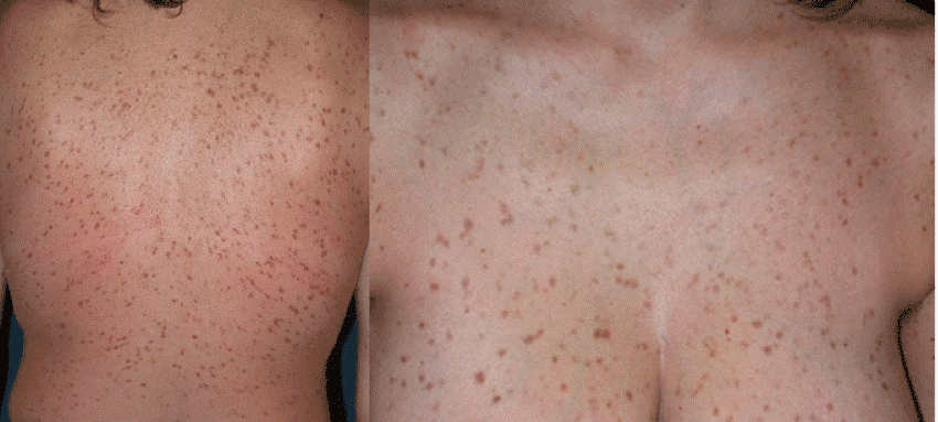Scattered brownish spots typical of mastocytosis across an adult's chest skin.