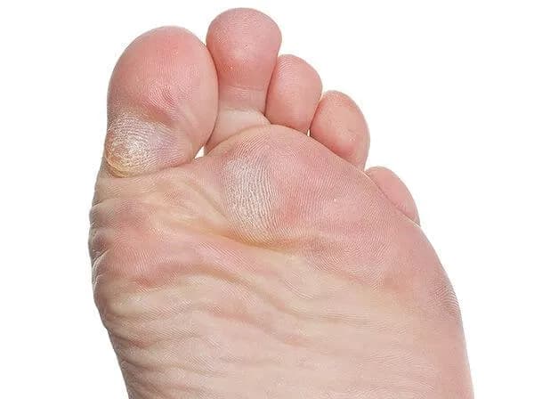 Thickened yellowish callus on the sole of the foot near the base of a toe, formed by prolonged pressure.