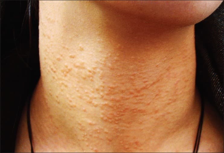Clustered tiny syringoma papules on the skin of the neck, benign growths of the sweat-gland ducts.