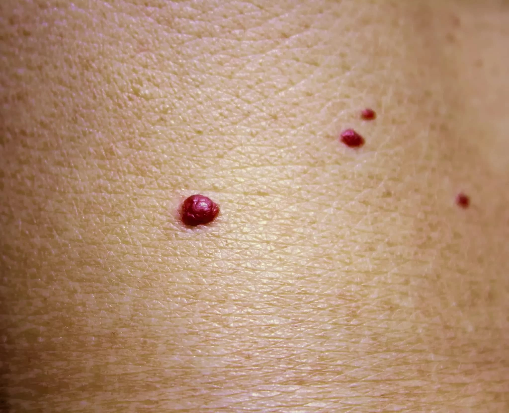 Several dark red cherry angiomas, raised benign vascular growths visible on the skin surface.