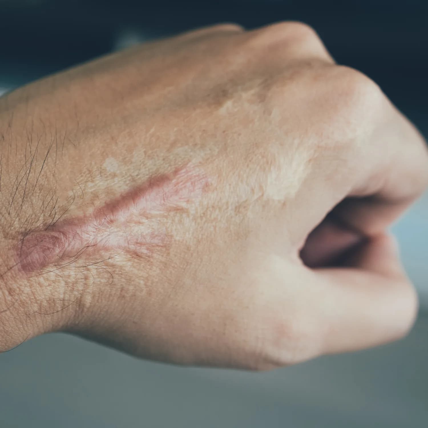 Healed linear scar on the back of the hand with a pink edge and lighter surrounding skin following an injury