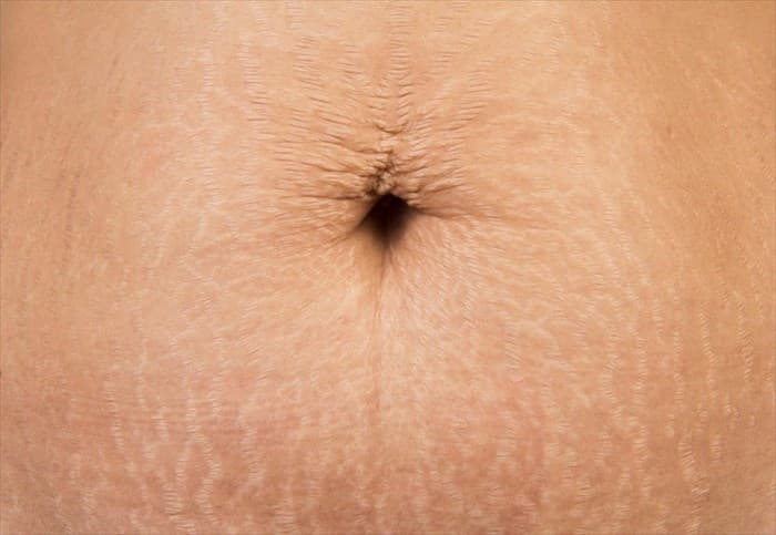 Pale atrophic stretch marks (striae distensae) on the abdominal skin around the navel following skin stretching