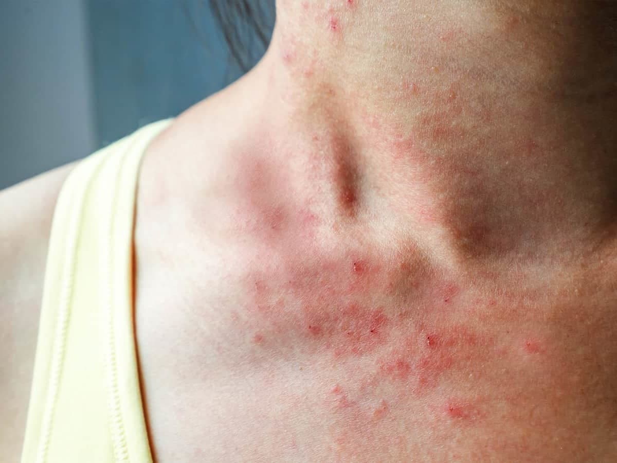 Red, itchy skin with a fine rash spreading over a woman's neck and upper chest