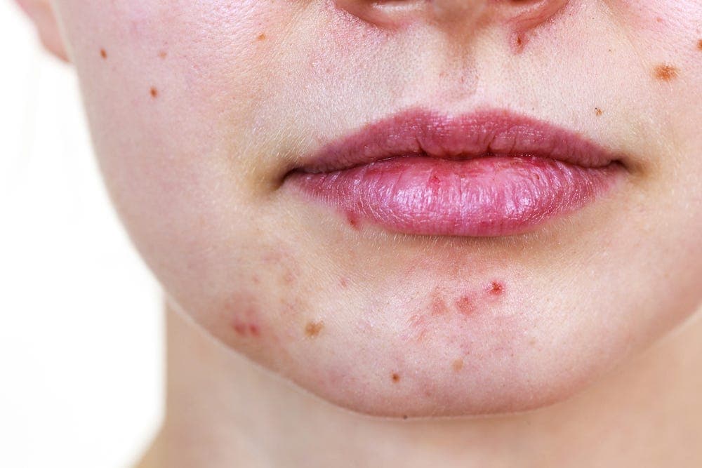 Adult woman's acne with breakouts and post-inflammatory marks around the lips and on the chin