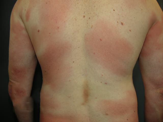Large reddish patches across the back and torso typical of the patch stage of mycosis fungoides
