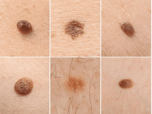 Collage of six photos showing various types of moles and nevi on the skin