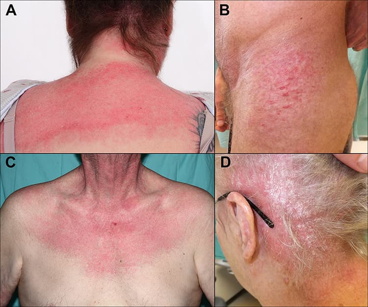 A four-panel set showing red, irritated skin on the neck, upper back, chest and behind the ear.