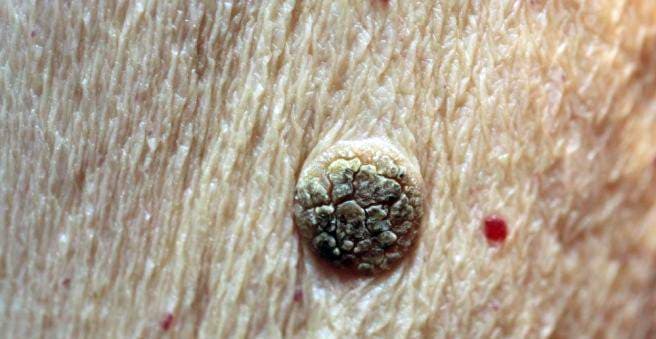 A raised, warty seborrheic keratosis with a rough surface on the skin, reviewed remotely by a dermatologist.
