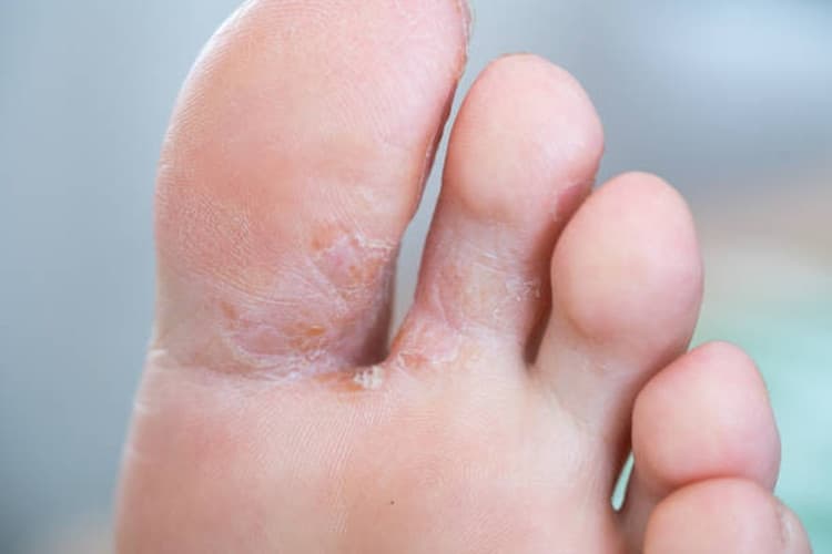 Peeling, scaly skin on the sole and between the toes characteristic of athlete's foot (tinea pedis)