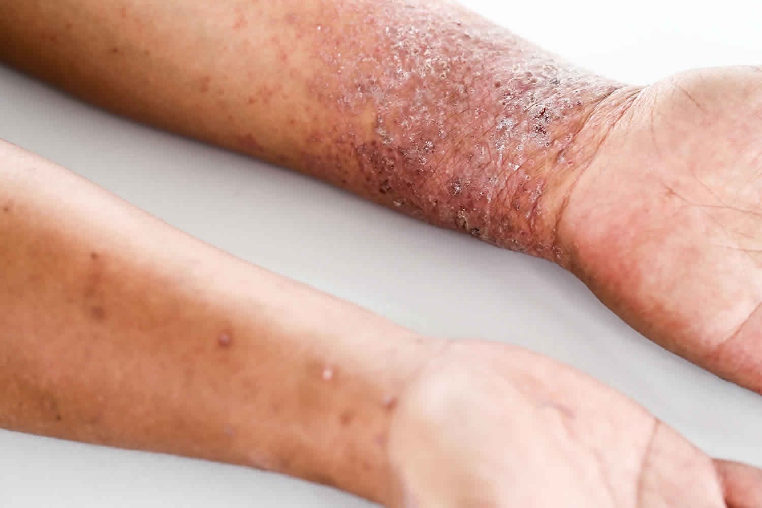 Red, scaly and inflamed skin of atopic dermatitis on the forearm and wrist