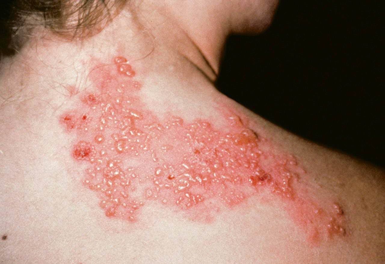 Clustered herpes zoster vesicles with redness spreading across the neck and shoulder