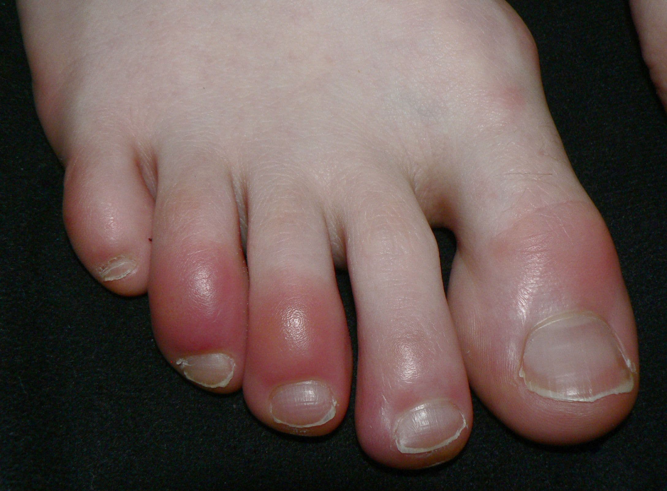 Red, swollen toes showing signs of chilblains (perniosis) caused by exposure to cold.