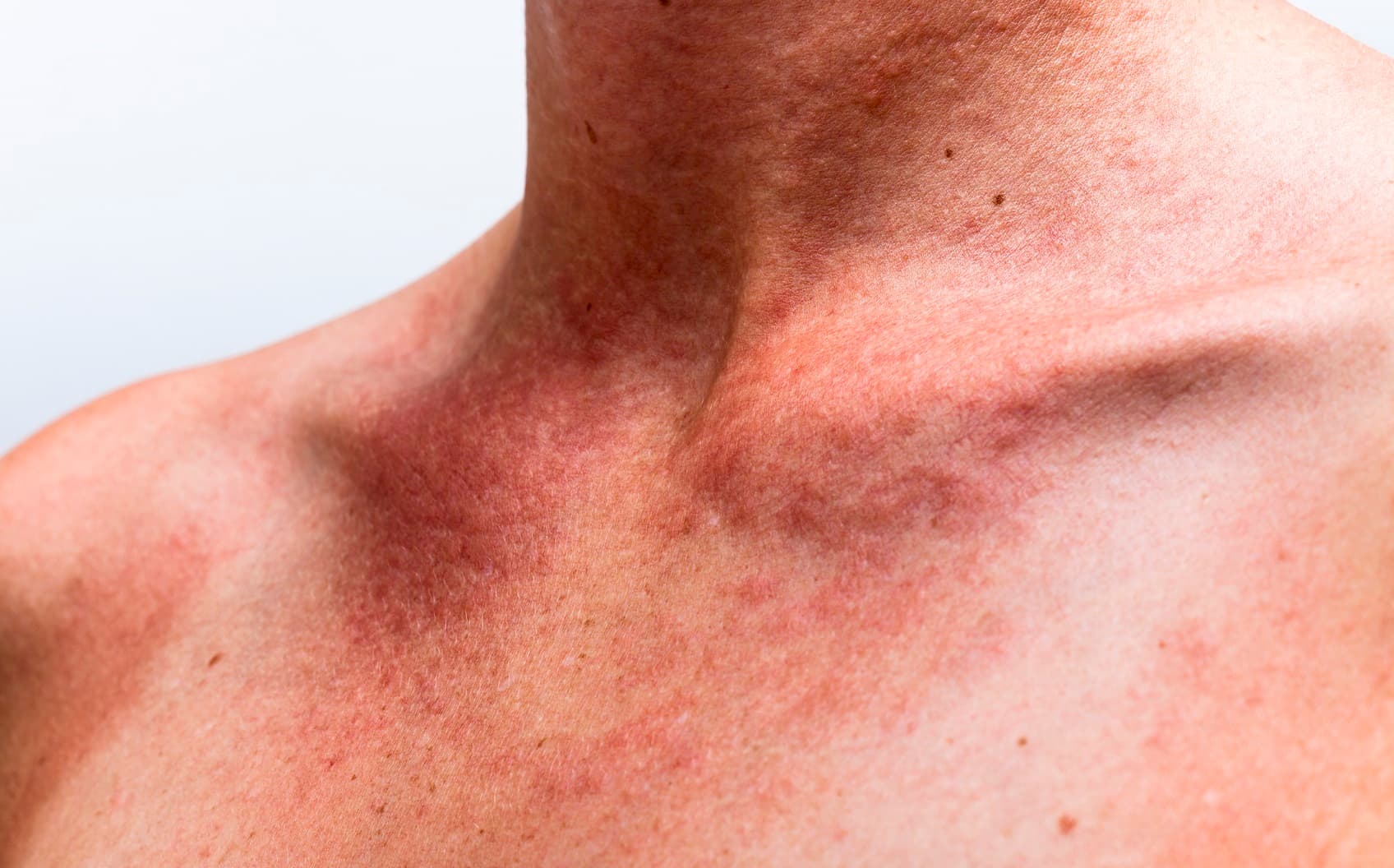 Reddened, irritated skin on the neck and decolletage, typical of polymorphic light eruption (sun allergy).