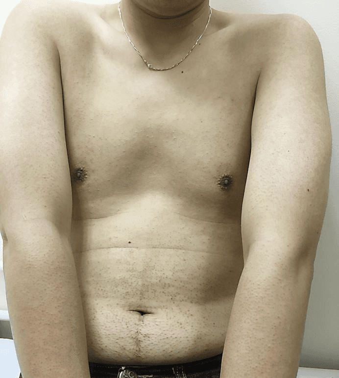 Fine follicular bumps on the trunk skin of a young man, characteristic of keratosis pilaris.