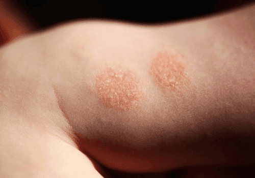 Two round, scaly patches of nummular dermatitis on a child's skin causing itching.