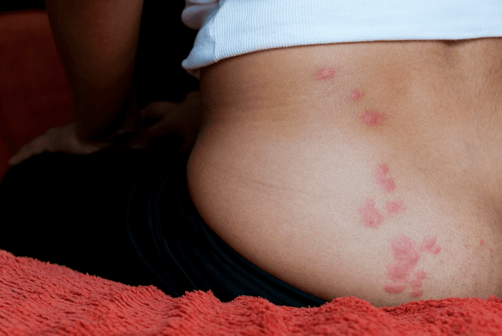 A linear cluster of red insect bites on the lower back and hip, a pattern often left by bedbugs.