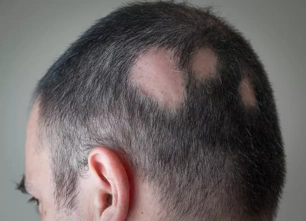 Several round patches of hair loss on the back of a man's head, typical of alopecia areata