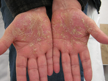 Both palms with thickened scaling, redness and pustules, typical of palmoplantar pustulosis