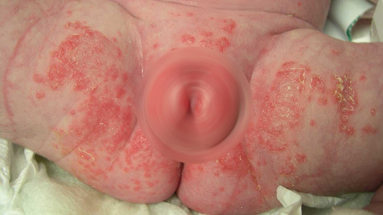 Infant nappy-area skin with bright redness and small satellite pustules typical of a candidal infection