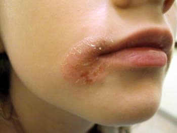 Red, cracked and flaking skin at the corner of the mouth typical of angular cheilitis.