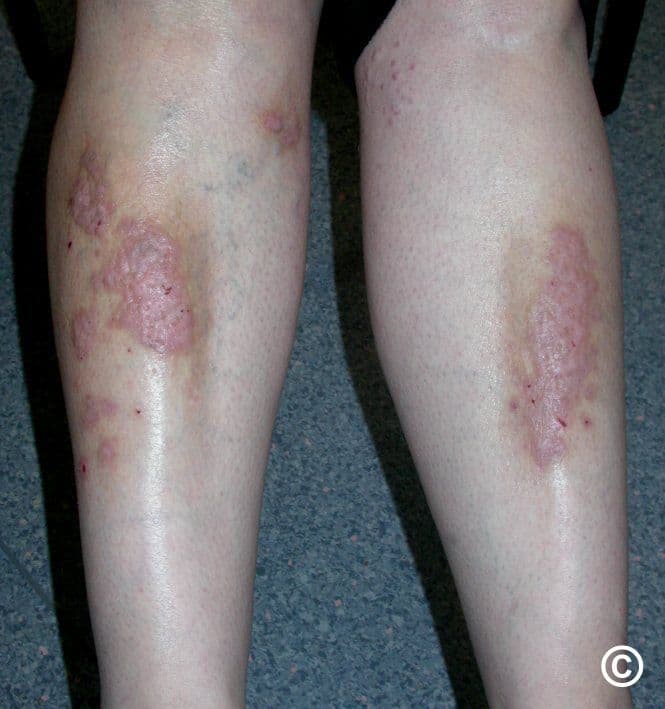 Thickened, reddened lichenified plaques of lichen simplex chronicus on both lower legs.