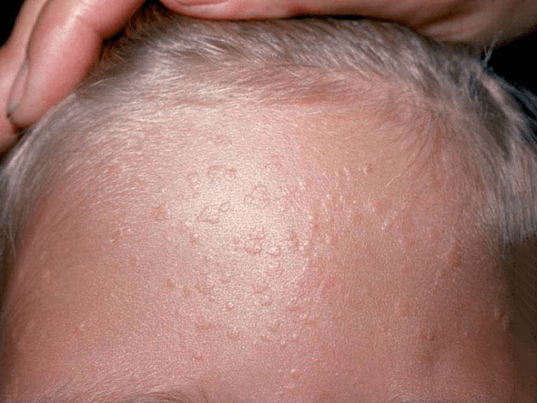 Tiny flat viral warts scattered across the skin of a child's forehead.