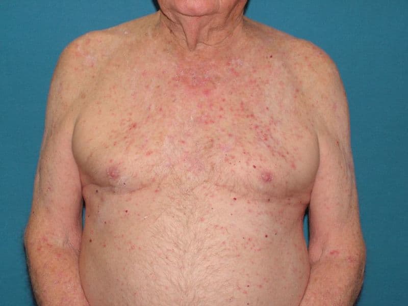 Small reddened papules of heat rash scattered across the chest and torso of an older man.