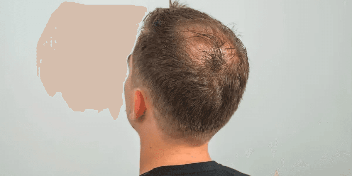 Back of a man's head with thinning hair at the crown, typical of androgenetic hair loss.