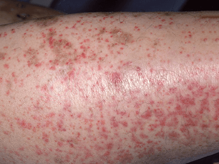 Lower leg densely covered with tiny reddish-purple petechiae, suggestive of vasculitis.