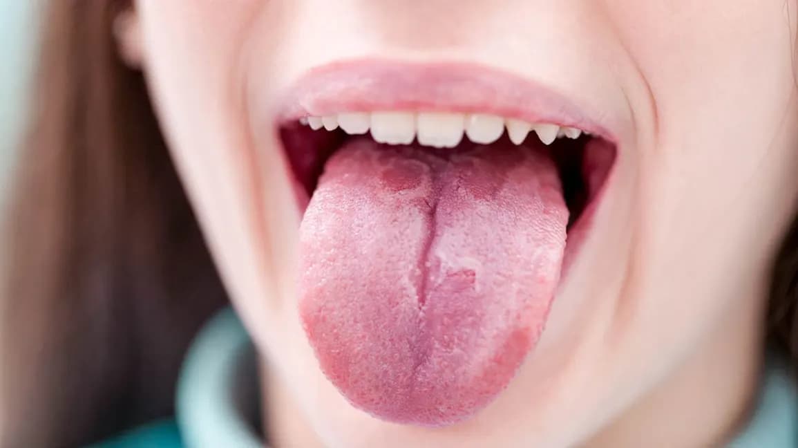 Adult's protruding tongue with map-like patches characteristic of geographic tongue.