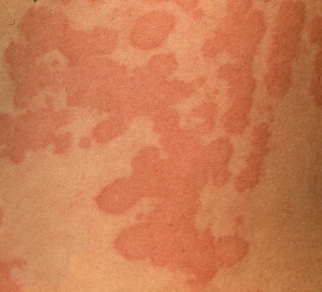 Large red welts and patches on the skin, characteristic of acute spontaneous urticaria