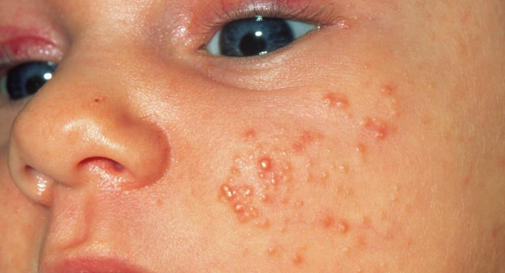 Small red papules and pustules on an infant's cheek, typical of infantile acne