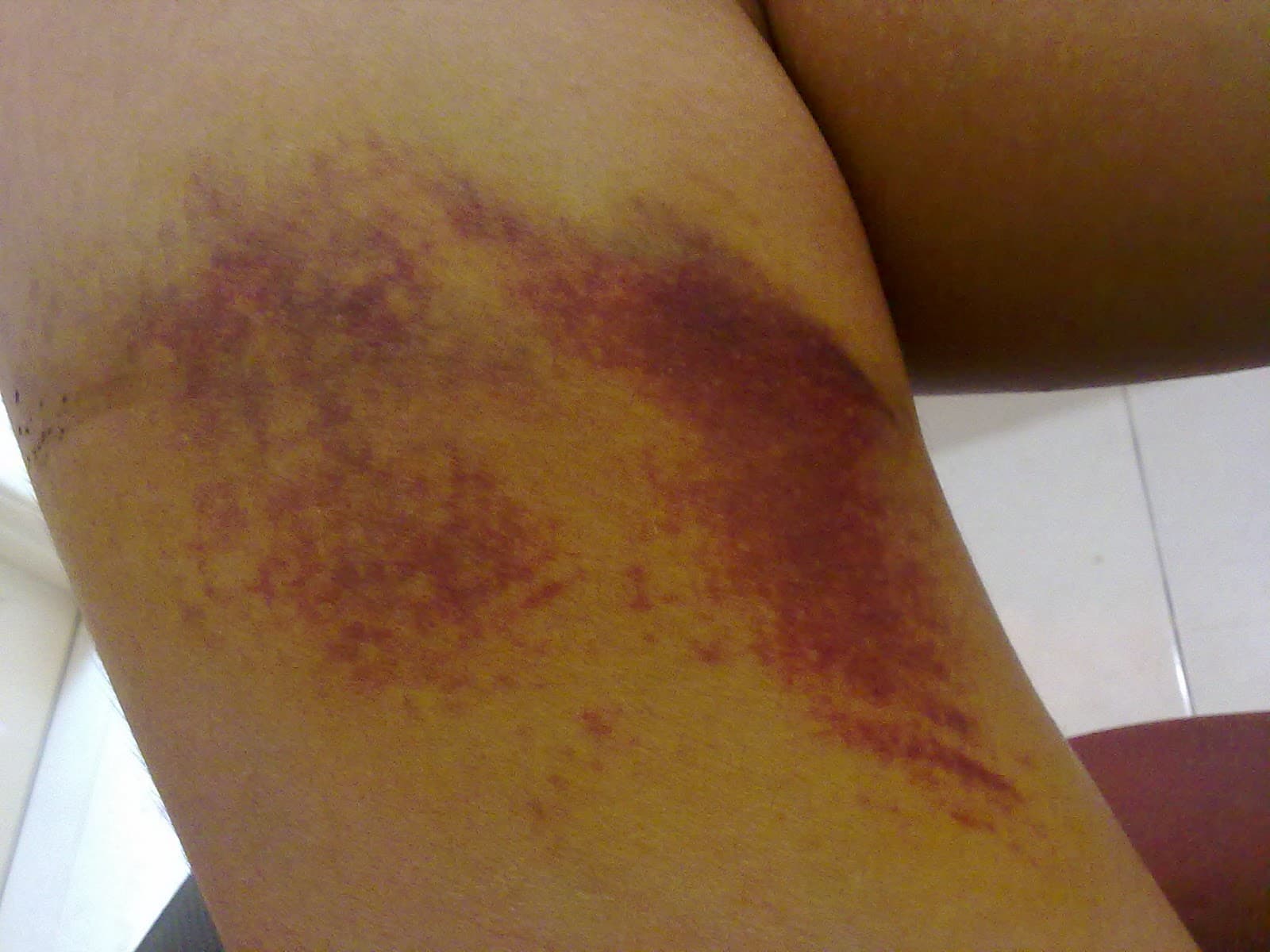Dark red-purple purpura patch on the skin of the leg, formed by tiny areas of bleeding beneath the skin surface.