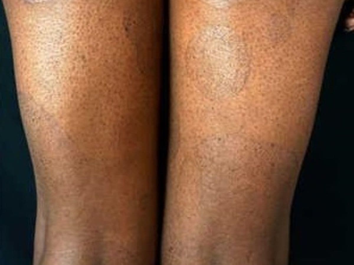Round, sharply demarcated scaly patches on the lower legs of darker skin, typical of pityriasis rotunda.