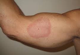 Localised granuloma annulare forming a red ring-shaped lesion on the skin of the arm.