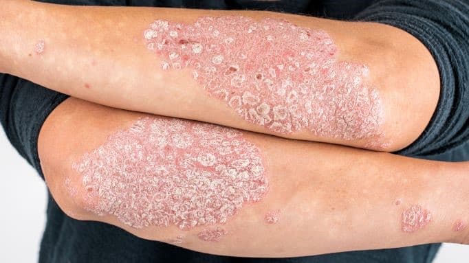 Red thick psoriasis plaques with silvery scales on both forearms and elbows.