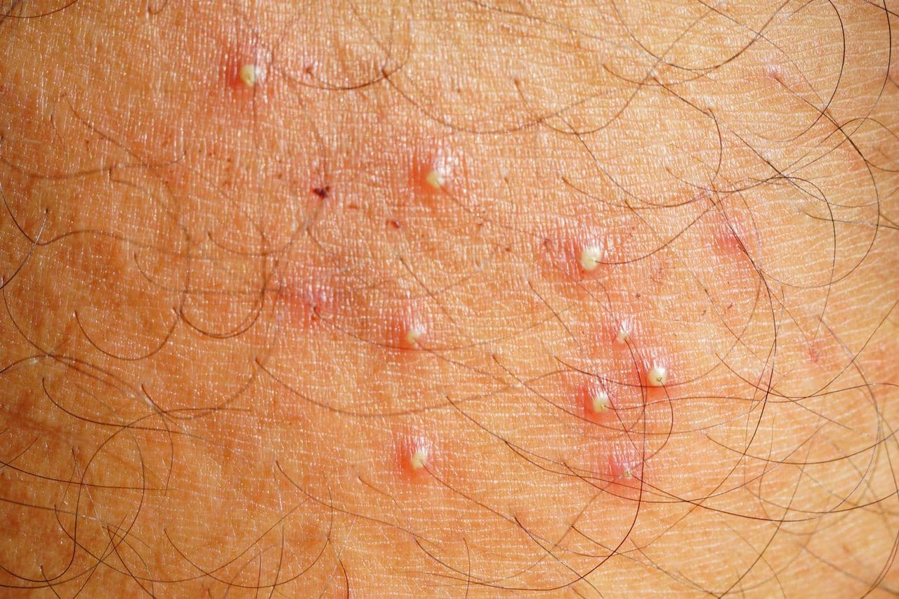 Hairy skin with small pustules centred on the hair follicles, the typical sign of folliculitis.