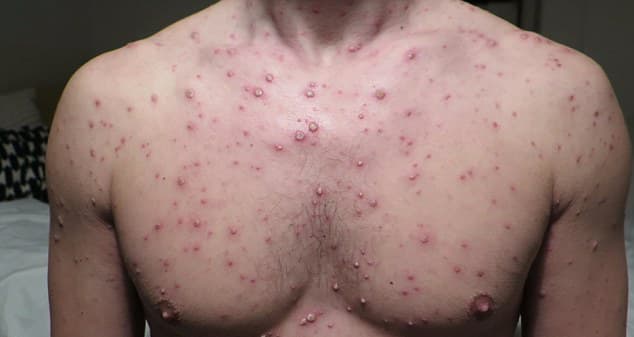 Chest and torso covered with numerous red papules and vesicles, the typical rash of chickenpox.
