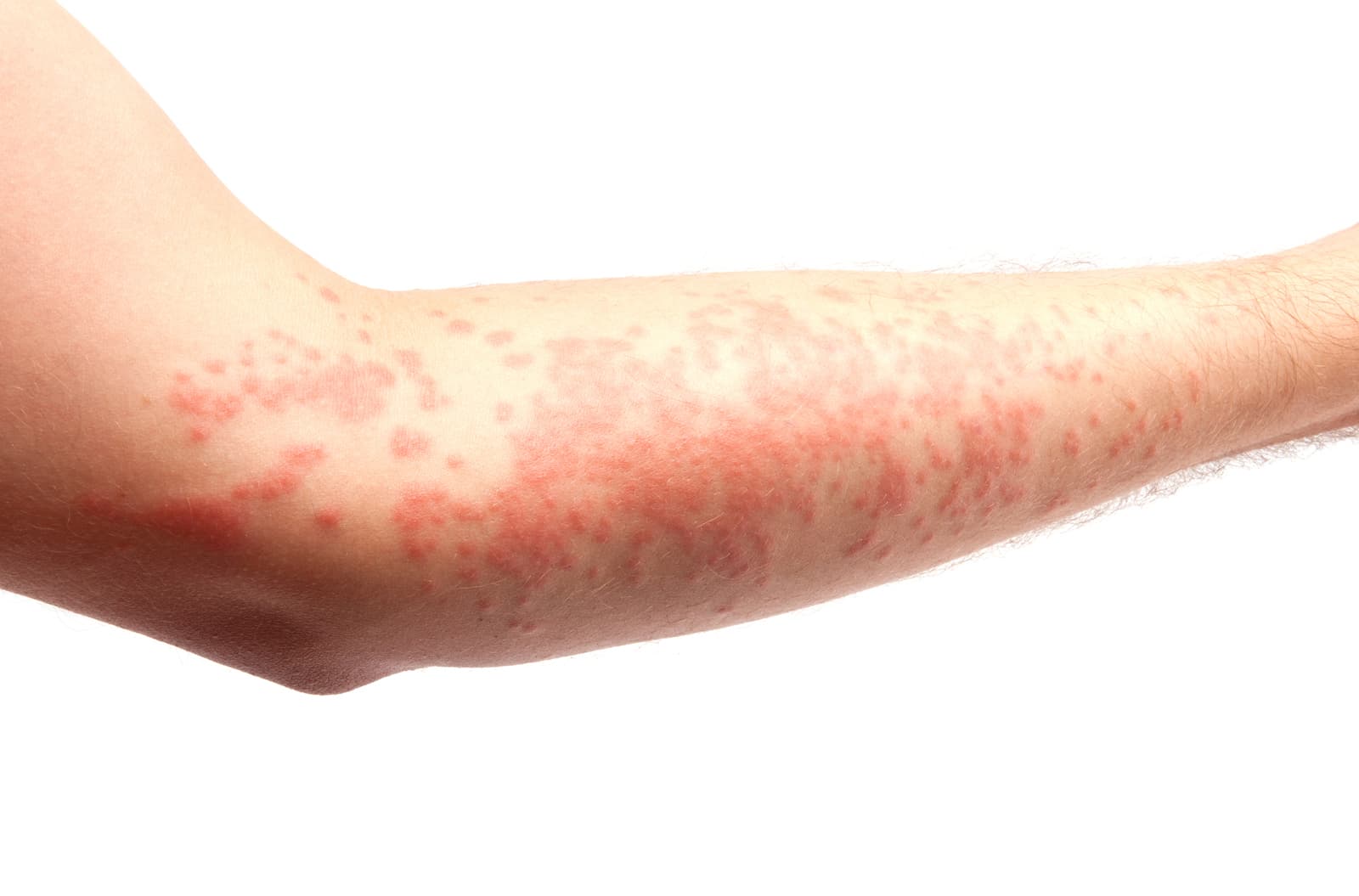 Reddened forearm skin near the elbow covered with a fine bumpy rash typical of contact dermatitis.