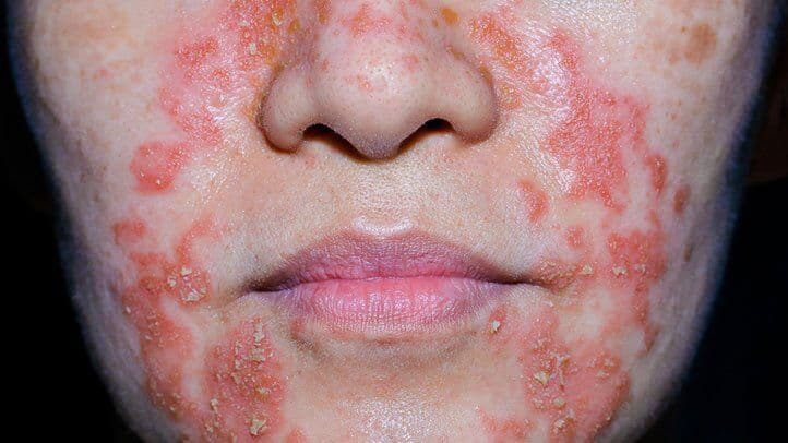 Severe perioral dermatitis with redness and scaling around the nose and mouth