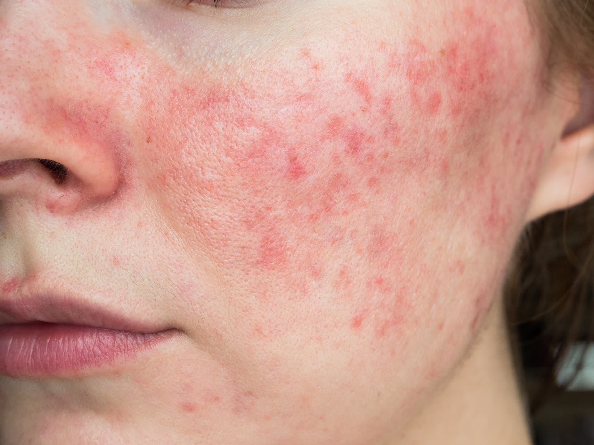 Reddened cheek skin with widespread inflammatory papules resembling rosacea