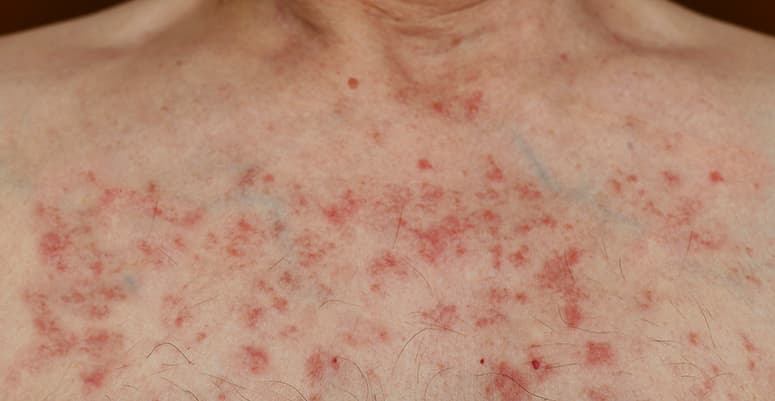 Upper back and neck skin with a widespread red papulopustular rash.